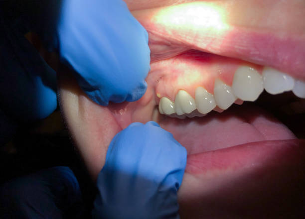 Best Emergency Root Canal Treatment in Leland, NC